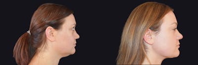 Neck Lift Before & After Gallery - Patient 412644 - Image 1