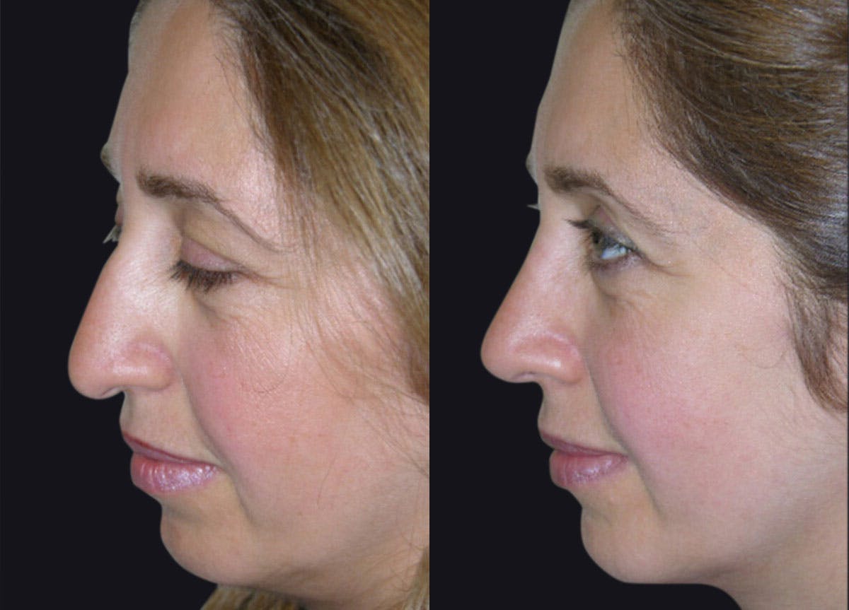 Rhinoplasty Before & After Gallery - Patient 177905938 - Image 1
