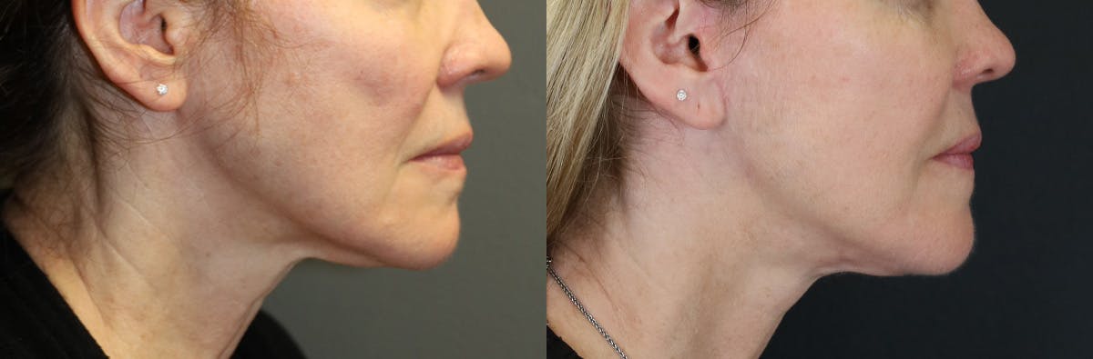 Neck Lift Before & After Gallery - Patient 464864 - Image 3
