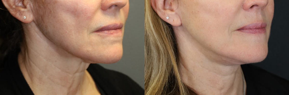 Neck Lift Before & After Gallery - Patient 464864 - Image 4