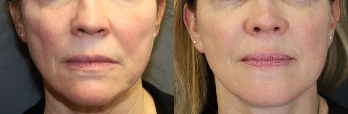 Neck Lift Before & After Gallery - Patient 464864 - Image 5