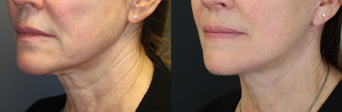 Neck Lift Before & After Gallery - Patient 464864 - Image 2