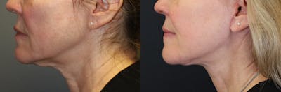 Neck Lift Before & After Gallery - Patient 464864 - Image 1