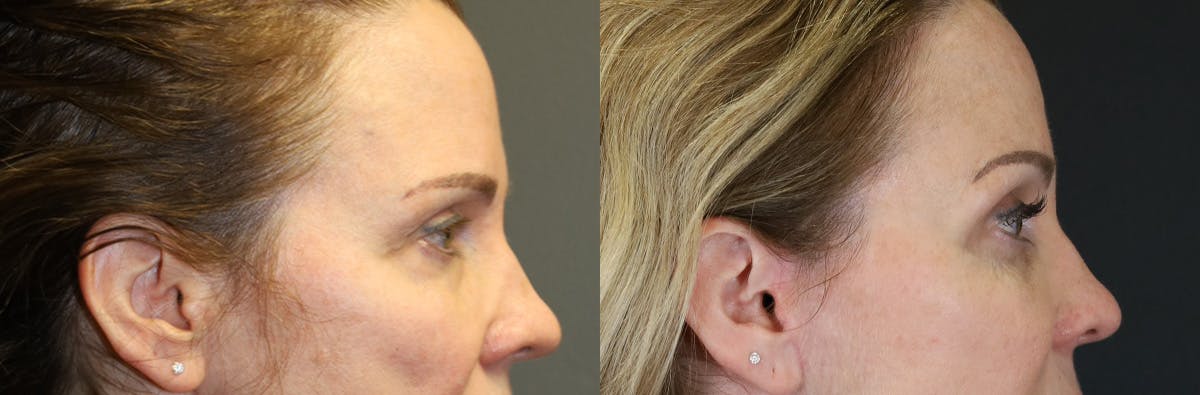 Blepharoplasty Before & After Gallery - Patient 369590 - Image 3