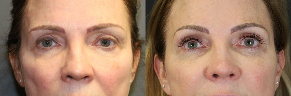 Blepharoplasty Before & After Gallery - Patient 369590 - Image 1