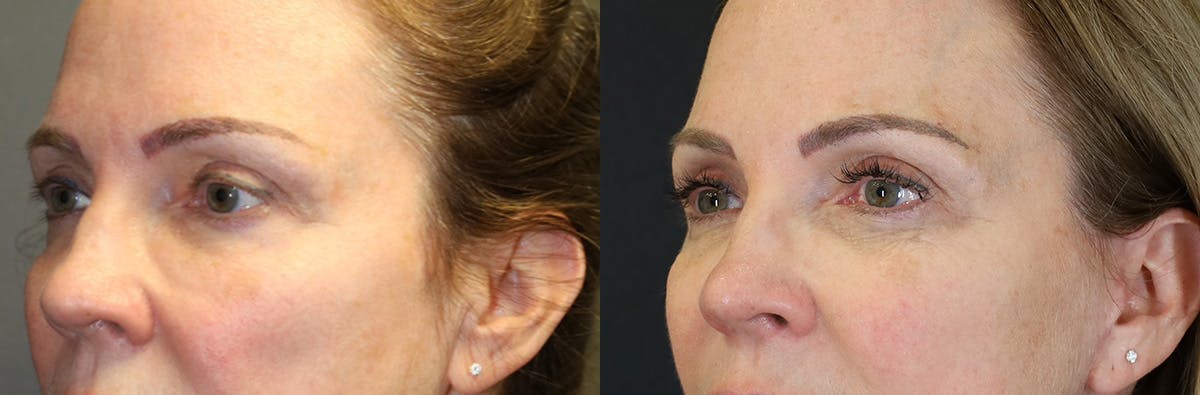 Blepharoplasty Before & After Gallery - Patient 369590 - Image 4