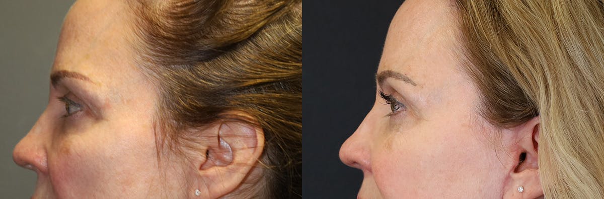 Blepharoplasty Before & After Gallery - Patient 369590 - Image 5