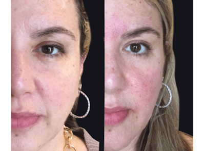 PDO Threads Before & After Gallery - Patient 177905345 - Image 1