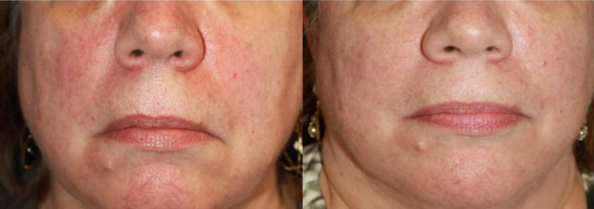 Laser Skin Rejuvenation Before & After Gallery - Patient 406578 - Image 1