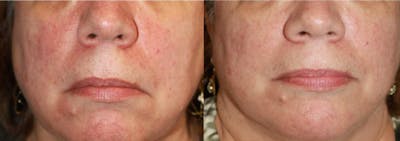 Laser Skin Rejuvenation Before & After Gallery - Patient 406578 - Image 1