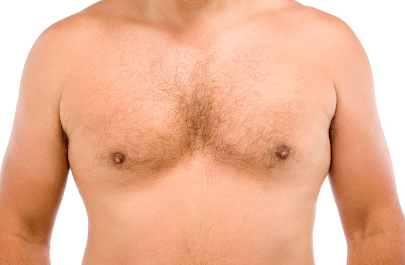 Cost Breakdown of Male Breast Reduction