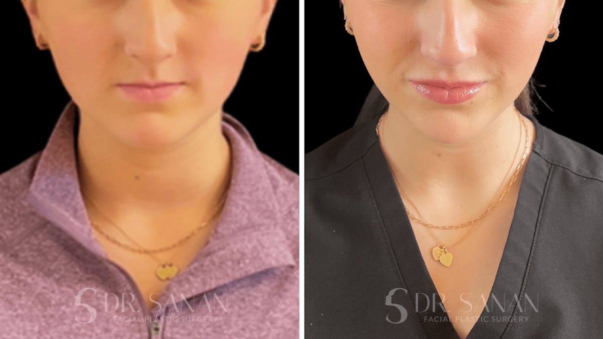 Dermal Fillers Before & After Gallery - Patient 220578 - Image 1