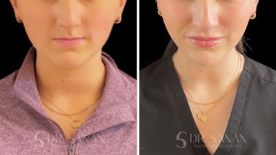Dermal Fillers Before & After Gallery - Patient 220578 - Image 1