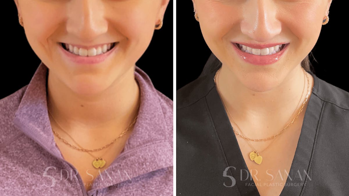 Dermal Fillers Before & After Gallery - Patient 220578 - Image 2
