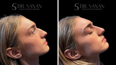 Dermal Fillers Before & After Gallery - Patient 157108 - Image 1