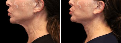 Neck Lift Before & After Gallery - Patient 196170 - Image 1