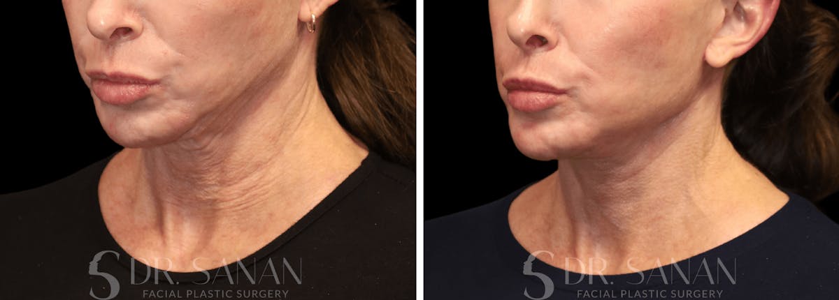 Neck Lift Before & After Gallery - Patient 196170 - Image 2