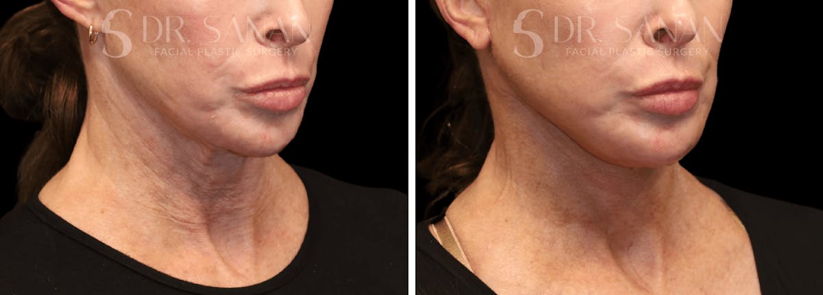 Neck Lift Before & After Gallery - Patient 196170 - Image 3