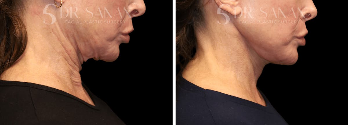 Neck Lift Before & After Gallery - Patient 196170 - Image 6