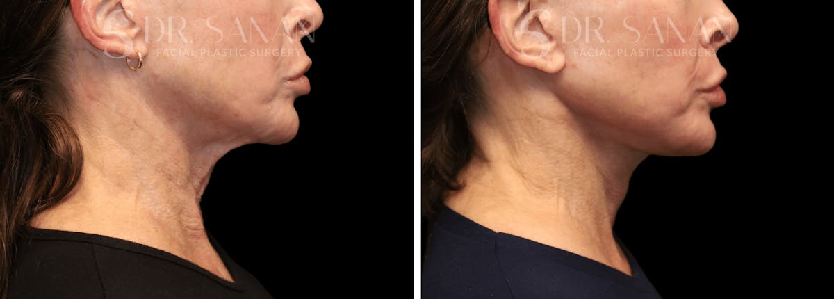 Neck Lift Before & After Gallery - Patient 196170 - Image 5