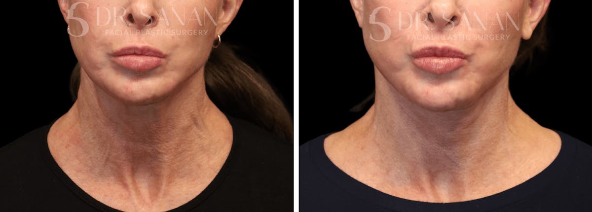 Neck Lift Before & After Gallery - Patient 196170 - Image 4