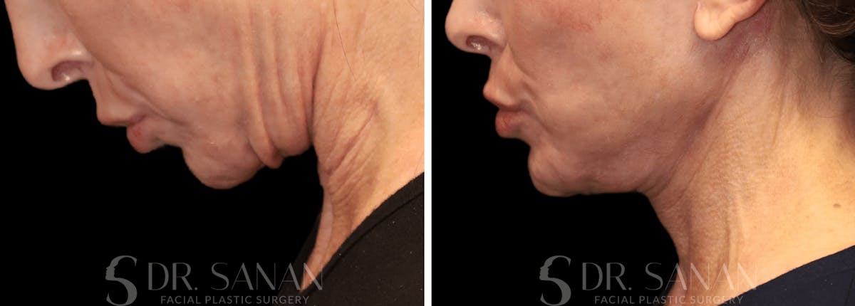 Neck Lift Before & After Gallery - Patient 196170 - Image 7