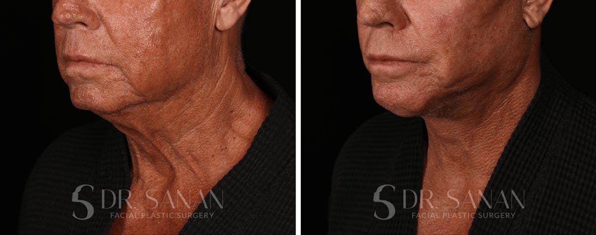 Deep Plane Facelift Before & After Gallery - Patient 773601 - Image 2