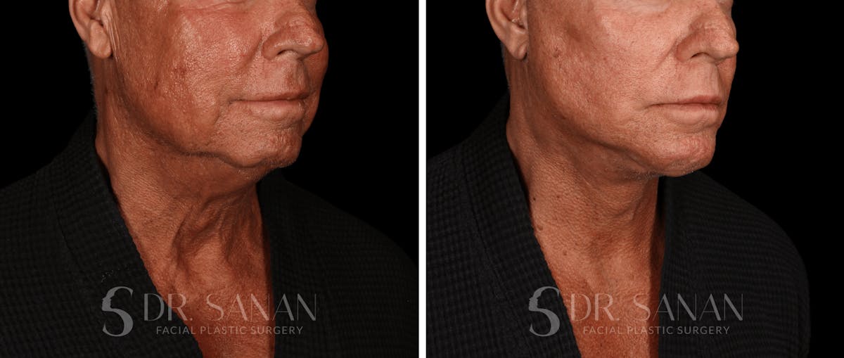 Deep Plane Facelift Before & After Gallery - Patient 773601 - Image 3