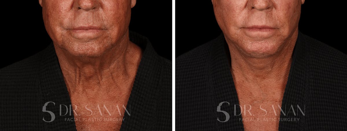 Deep Plane Facelift Before & After Gallery - Patient 773601 - Image 4