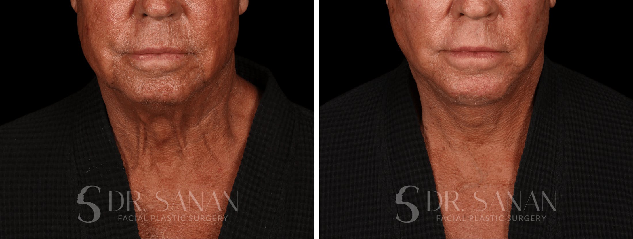 Deep Plane Facelift Before & After Gallery - Patient 193173 - Image 3