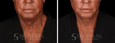 Deep Plane Facelift Before & After Gallery - Patient 773601 - Image 1