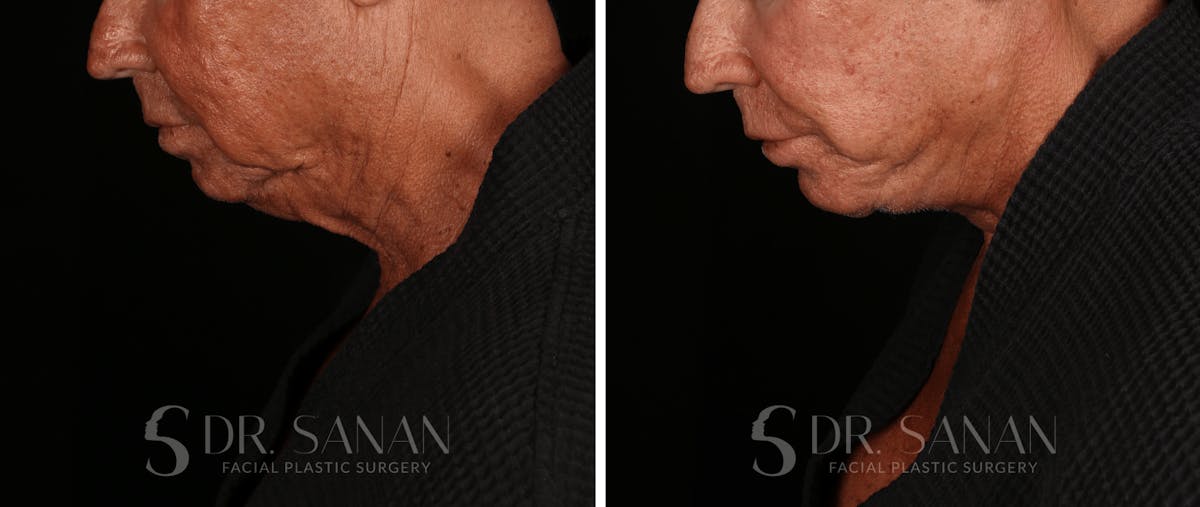 Deep Plane Facelift Before & After Gallery - Patient 773601 - Image 5