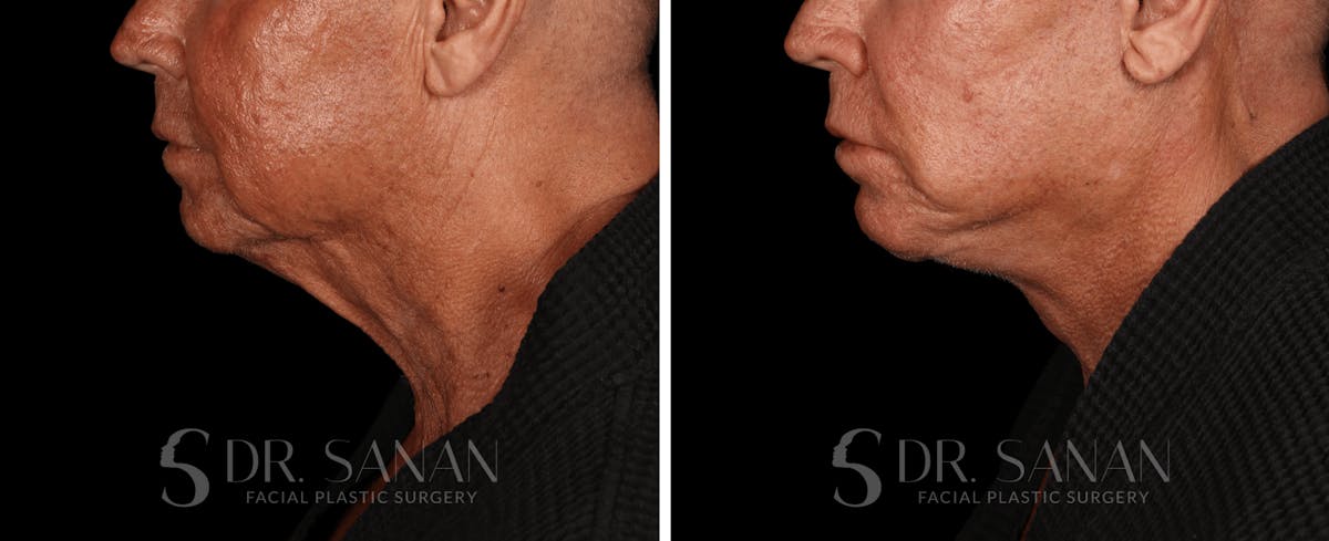 Deep Plane Facelift Before & After Gallery - Patient 773601 - Image 1