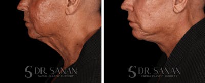 Deep Plane Facelift Before & After Gallery - Patient 773601 - Image 1