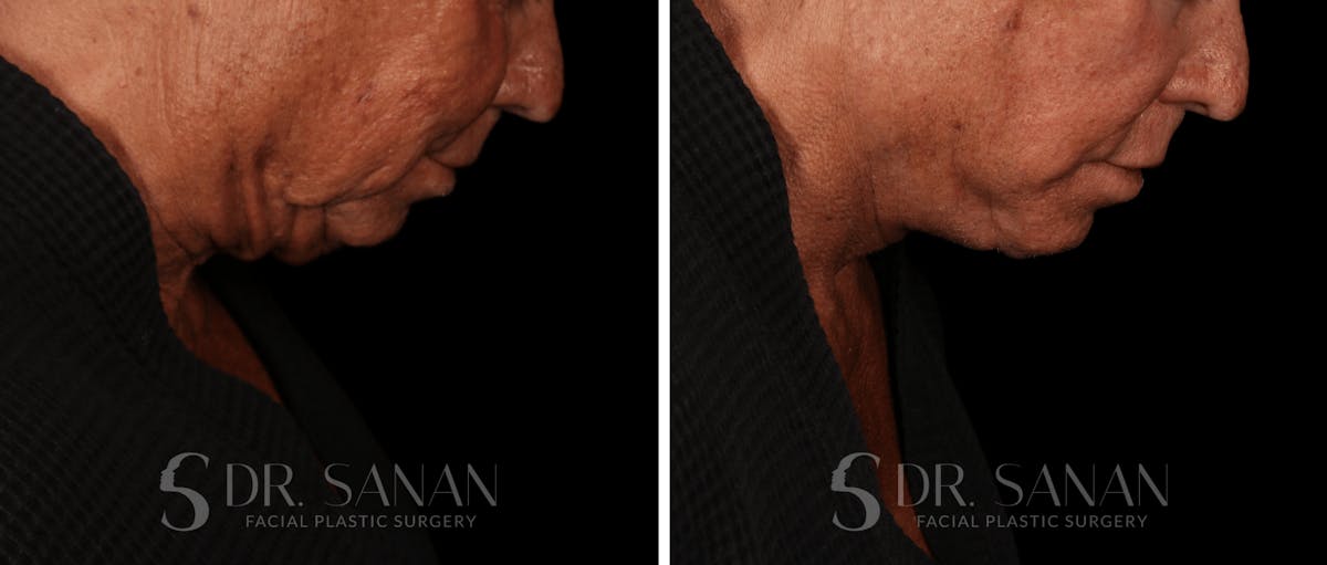 Deep Plane Facelift Before & After Gallery - Patient 773601 - Image 6