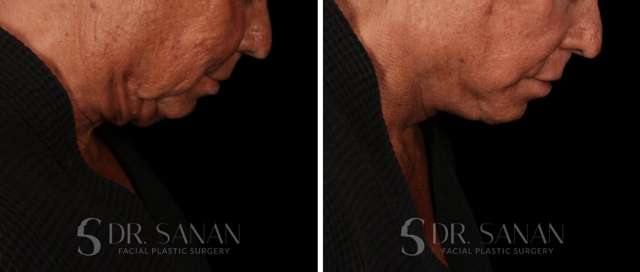 Deep Plane Facelift Before & After Gallery - Patient 193173 - Image 7