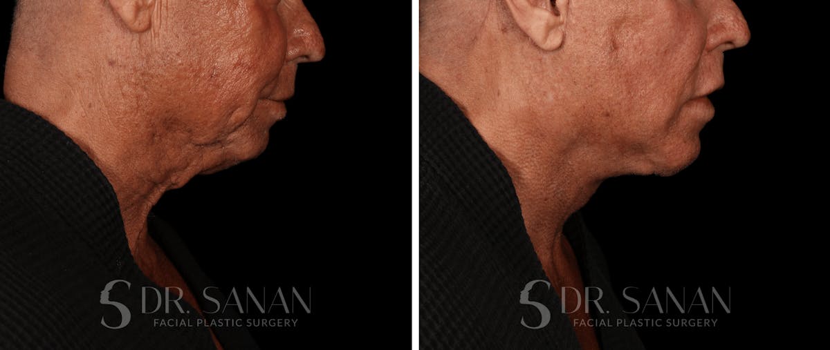 Deep Plane Facelift Before & After Gallery - Patient 773601 - Image 7