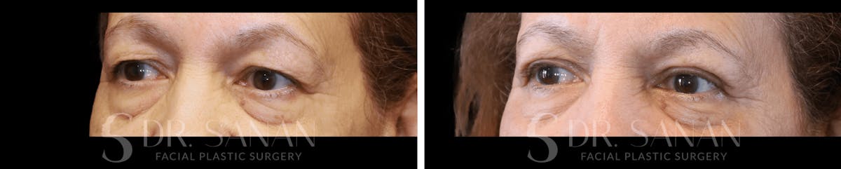 Blepharoplasty Before & After Gallery - Patient 116902 - Image 1