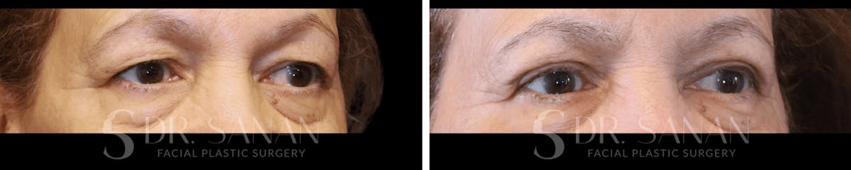 Blepharoplasty Before & After Gallery - Patient 116902 - Image 2