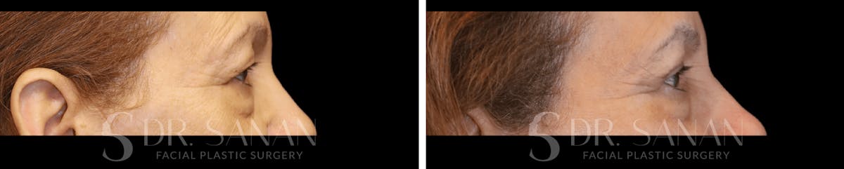 Blepharoplasty Before & After Gallery - Patient 116902 - Image 5
