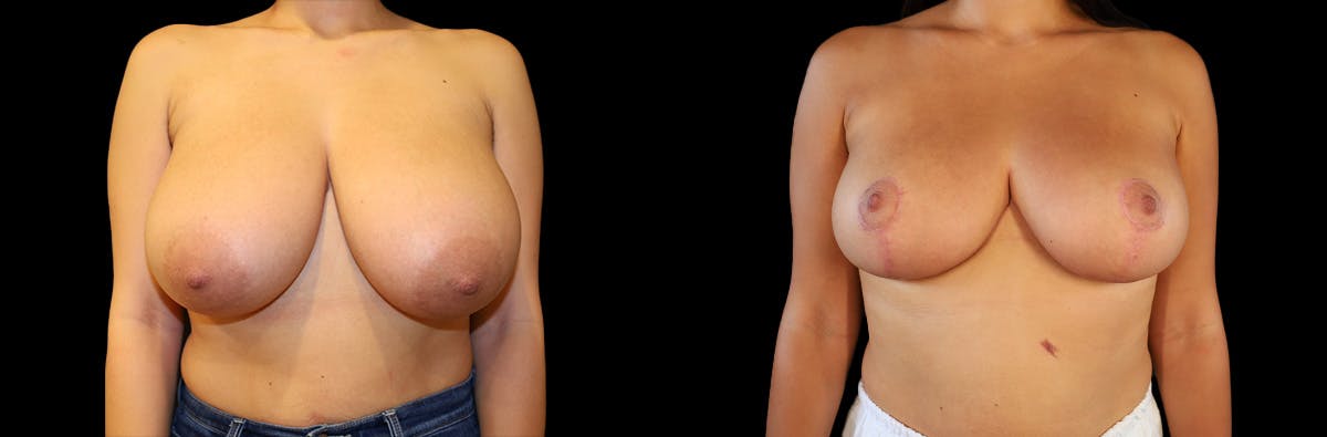 Breast Reduction Before & After Gallery - Patient 223759 - Image 1