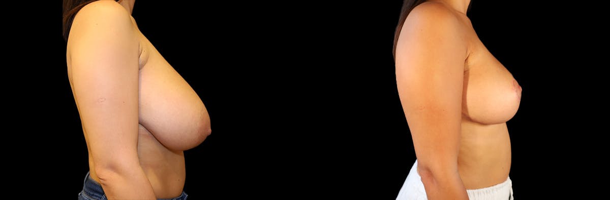 Breast Reduction Before & After Gallery - Patient 223759 - Image 3