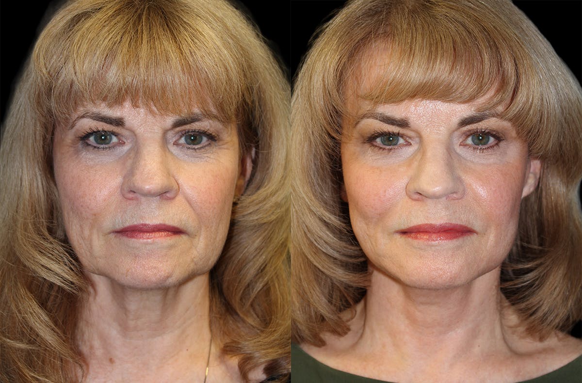 Facelift Before & After Gallery - Patient 219212 - Image 1