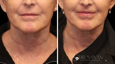 Lip Lift Before & After Gallery - Patient 161311 - Image 1