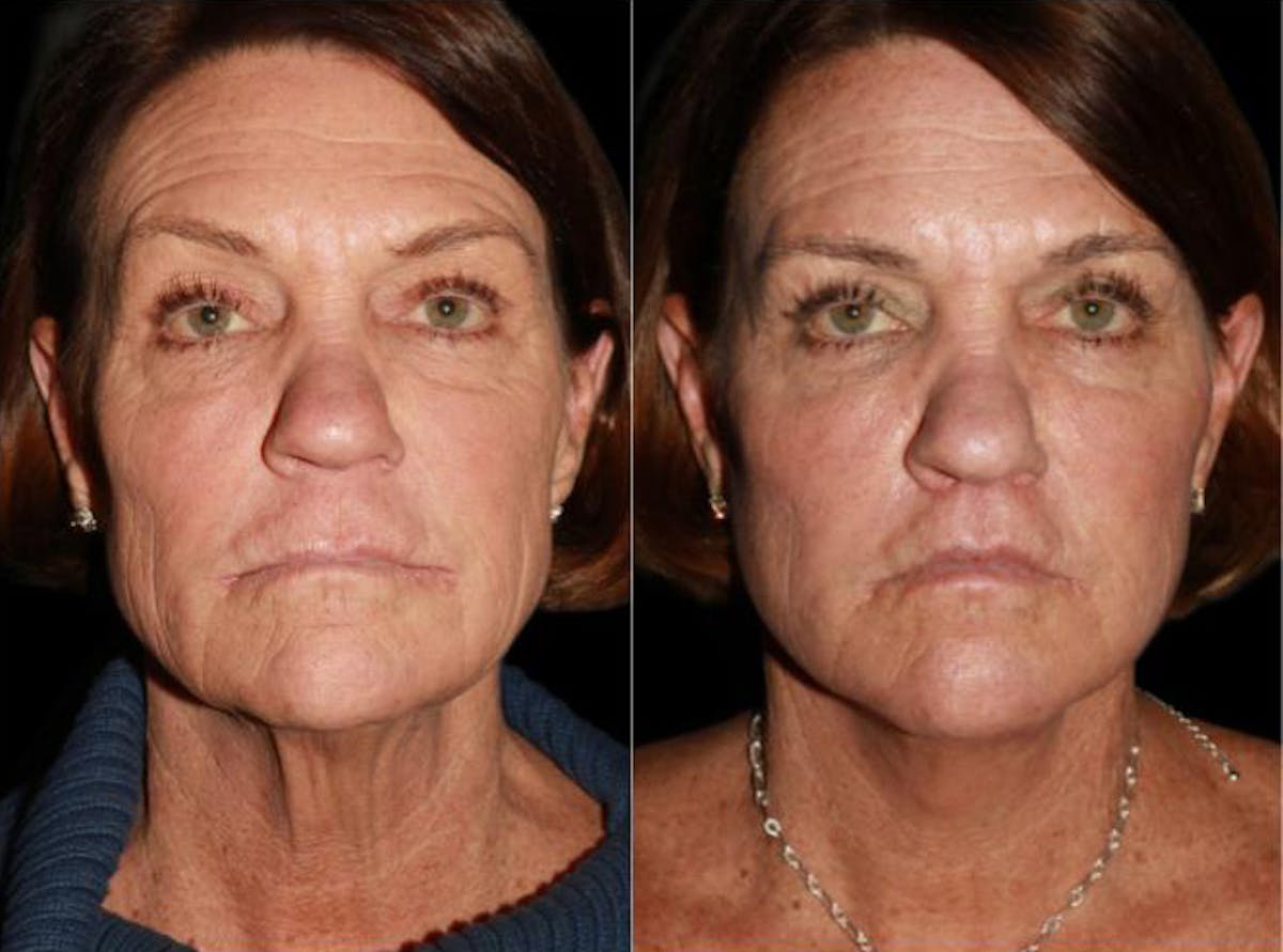 Facelift Before & After Gallery - Patient 289242 - Image 2