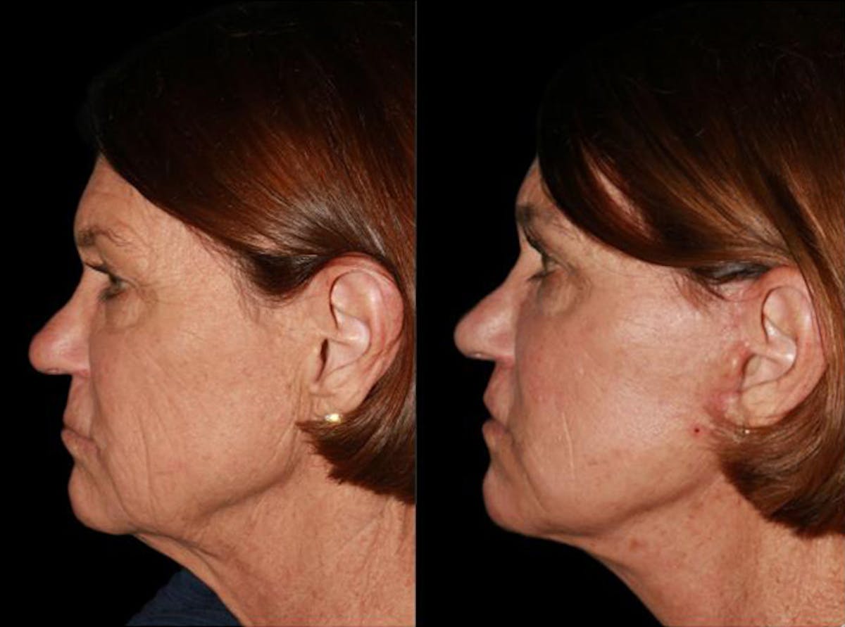 Facelift Before & After Gallery - Patient 289242 - Image 1