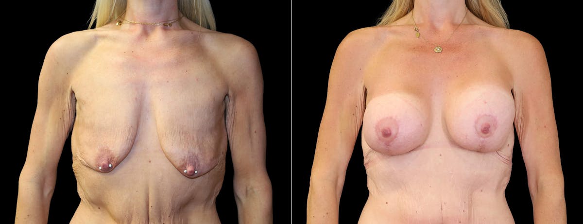 Breast Augmentation Before & After Gallery - Patient 393262 - Image 1