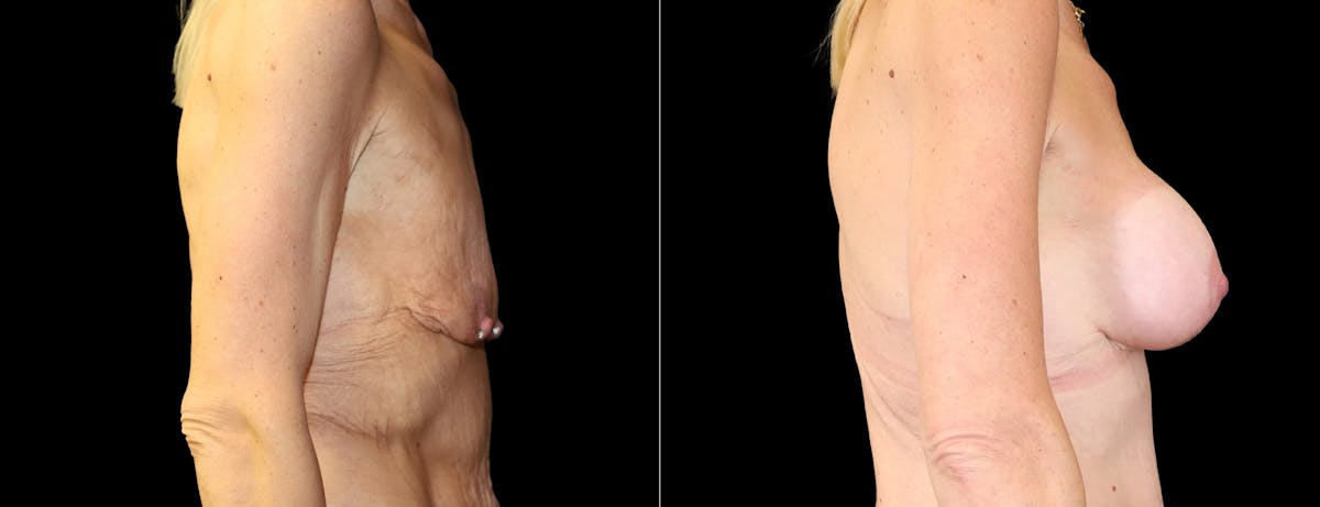 Breast Augmentation Before & After Gallery - Patient 393262 - Image 3