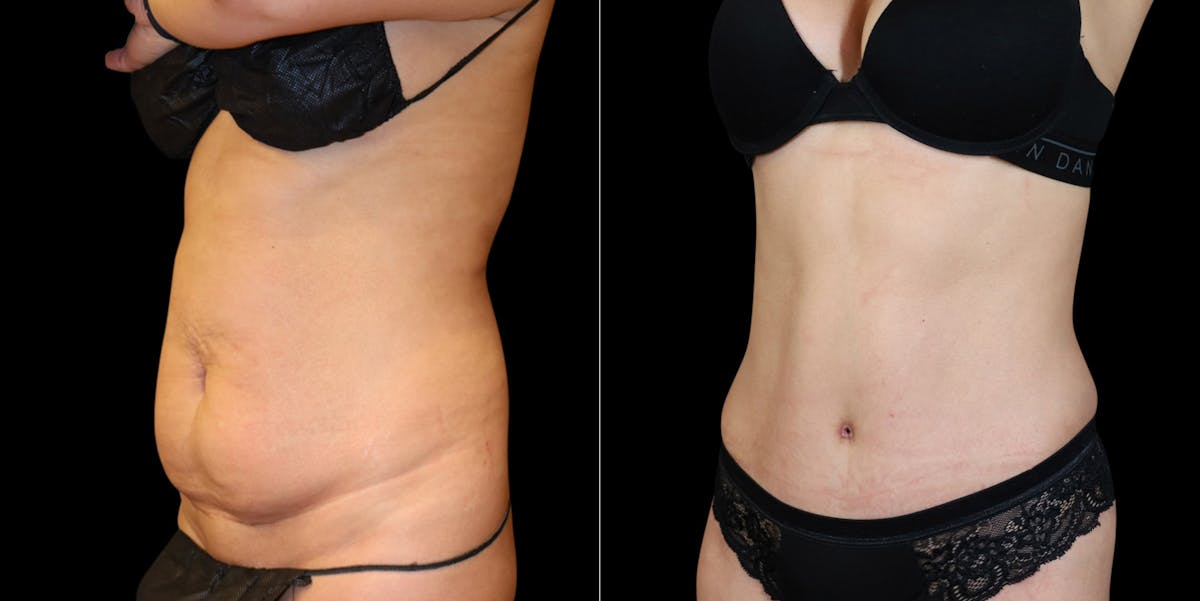 Abdominoplasty (Tummy Tuck) Before & After Gallery - Patient 371350 - Image 4