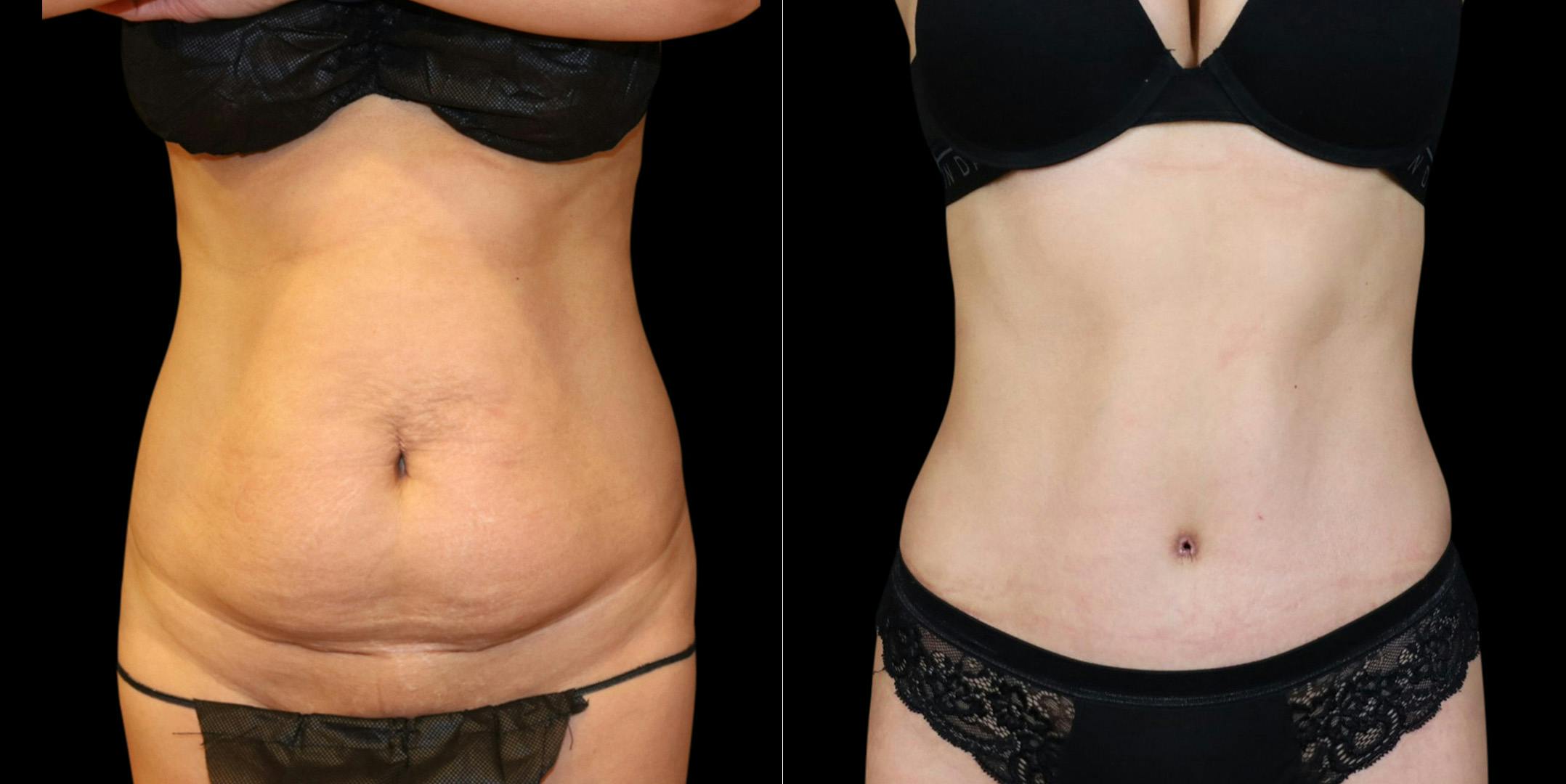 Abdominoplasty (Tummy Tuck) Before & After Gallery - Patient 371350 - Image 1